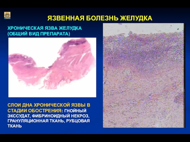 ЯЗВЕННАЯ БОЛЕЗНЬ ЖЕЛУДКА ХРОНИЧЕСКАЯ ЯЗВА ЖЕЛУДКА (ОБЩИЙ ВИД ПРЕПАРАТА) СЛОИ ДНА