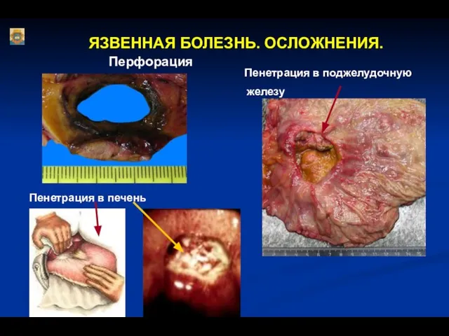 ЯЗВЕННАЯ БОЛЕЗНЬ. ОСЛОЖНЕНИЯ. Перфорация Пенетрация в печень Пенетрация в поджелудочную железу