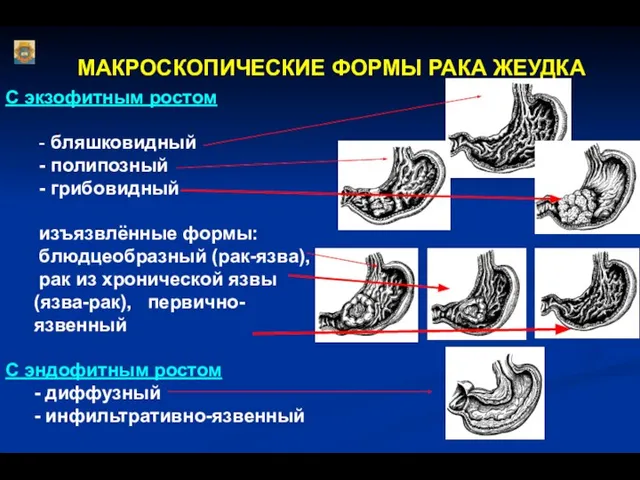 МАКРОСКОПИЧЕСКИЕ ФОРМЫ РАКА ЖЕУДКА С экзофитным ростом - бляшковидный - полипозный