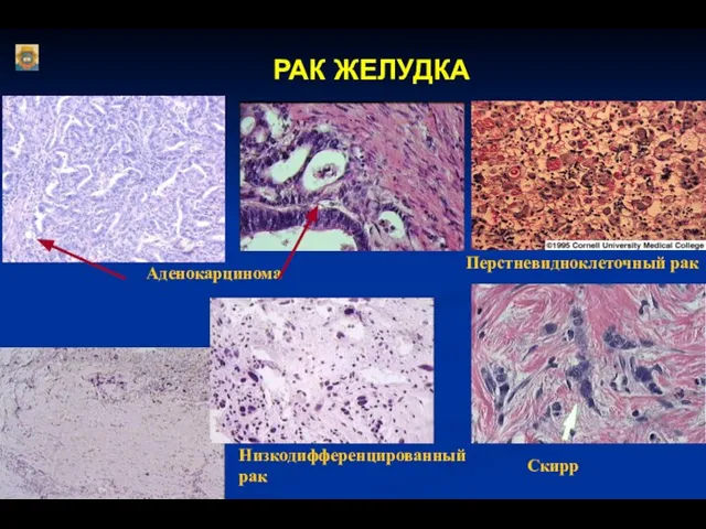 РАК ЖЕЛУДКА Аденокарцинома Перстневидноклеточный рак Скирр Низкодифференцированный рак