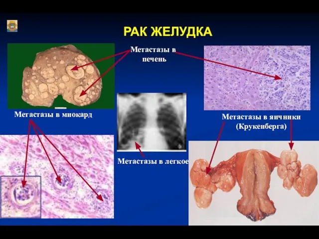 РАК ЖЕЛУДКА Метастазы в печень Метастазы в миокард Метастазы в яичники (Крукенберга) Метастазы в легкое