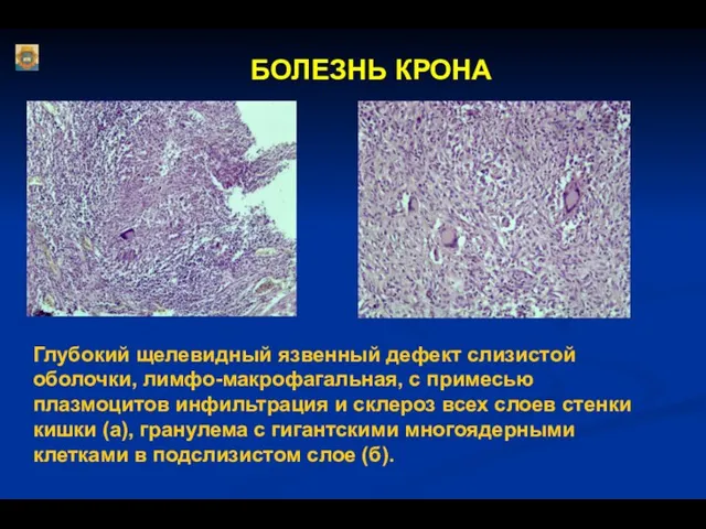 БОЛЕЗНЬ КРОНА Глубокий щелевидный язвенный дефект слизистой оболочки, лимфо-макрофагальная, с примесью