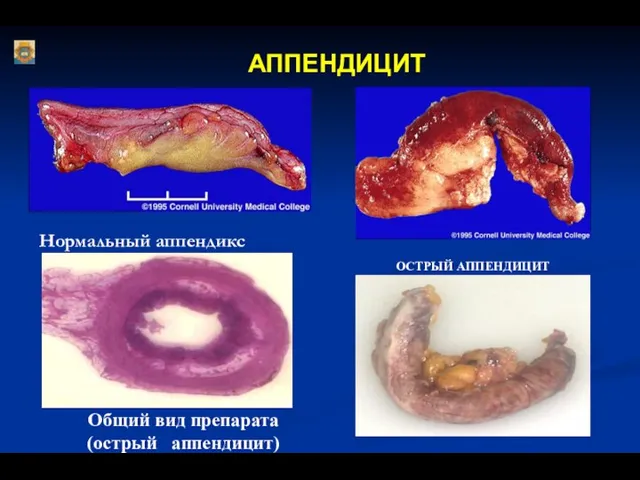 АППЕНДИЦИТ Нормальный аппендикс ОСТРЫЙ АППЕНДИЦИТ Общий вид препарата (острый аппендицит)