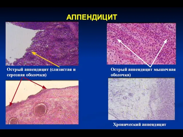 АППЕНДИЦИТ Острый аппендицит (слизистая и серозная оболочки) Острый аппендицит мышечная оболочка) Хронический аппендицит