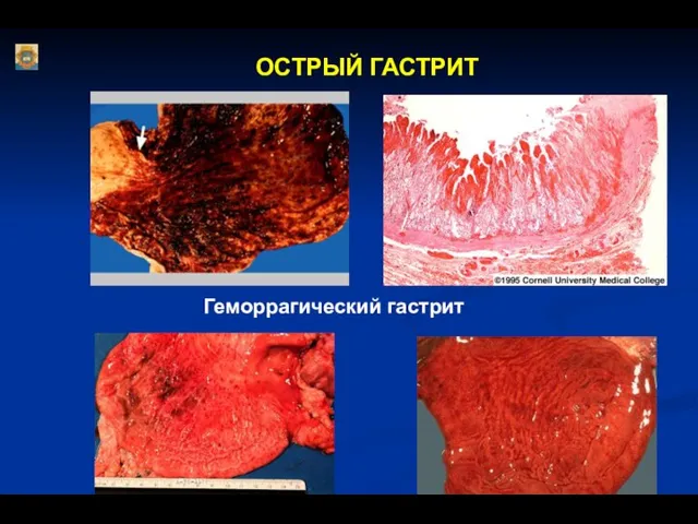 ОСТРЫЙ ГАСТРИТ Геморрагический гастрит