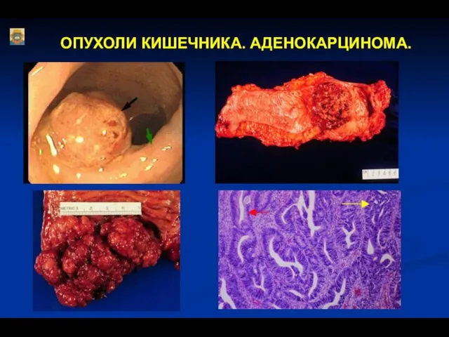 ОПУХОЛИ КИШЕЧНИКА. АДЕНОКАРЦИНОМА.