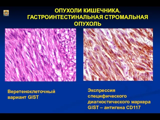 ОПУХОЛИ КИШЕЧНИКА. ГАСТРОИНТЕСТИНАЛЬНАЯ СТРОМАЛЬНАЯ ОПУХОЛЬ Веретеноклеточный вариант GIST Экспрессия специфического диагностического маркера GIST – антигена CD117