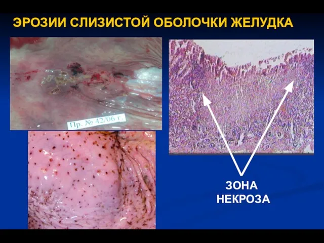 ЭРОЗИИ СЛИЗИСТОЙ ОБОЛОЧКИ ЖЕЛУДКА ЗОНА НЕКРОЗА