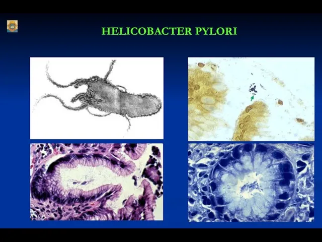 HELICOBACTER PYLORI