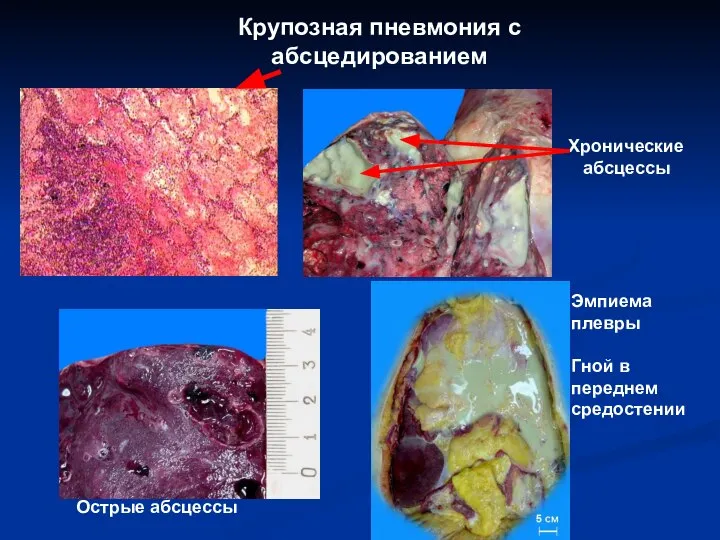 Хронические абсцессы Крупозная пневмония с абсцедированием Острые абсцессы Эмпиема плевры Гной в переднем средостении