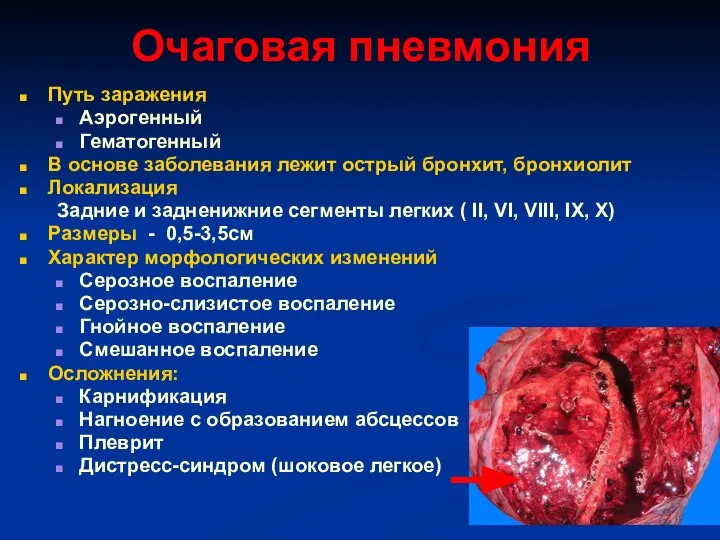 Очаговая пневмония Путь заражения Аэрогенный Гематогенный В основе заболевания лежит острый