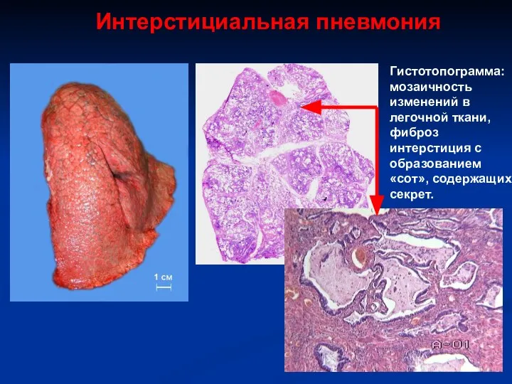 Интерстициальная пневмония Гистотопограмма: мозаичность изменений в легочной ткани, фиброз интерстиция с образованием «сот», содержащих секрет.