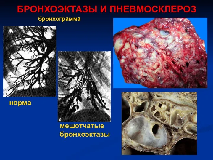 БРОНХОЭКТАЗЫ И ПНЕВМОСКЛЕРОЗ бронхограмма норма мешотчатые бронхоэктазы