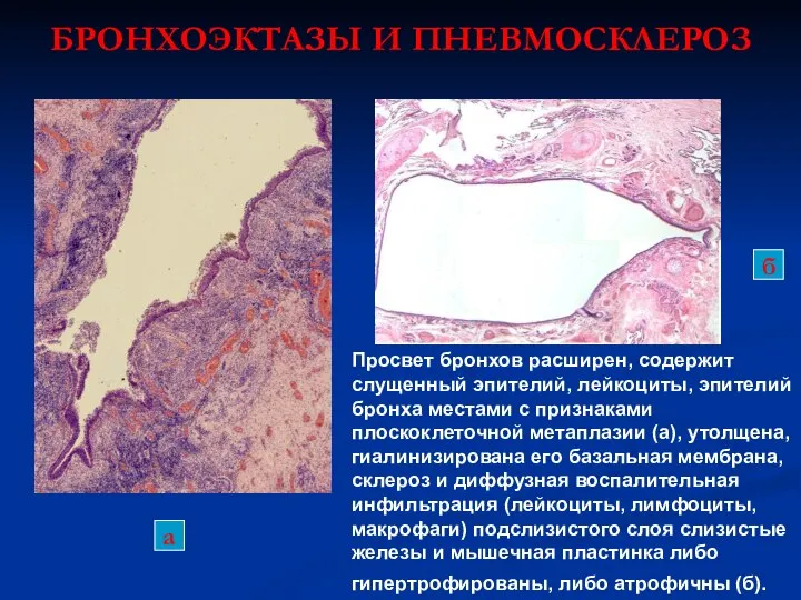 БРОНХОЭКТАЗЫ И ПНЕВМОСКЛЕРОЗ Просвет бронхов расширен, содержит слущенный эпителий, лейкоциты, эпителий