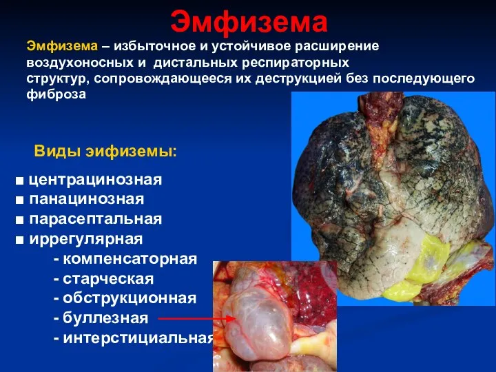 Эмфизема Эмфизема – избыточное и устойчивое расширение воздухоносных и дистальных респираторных