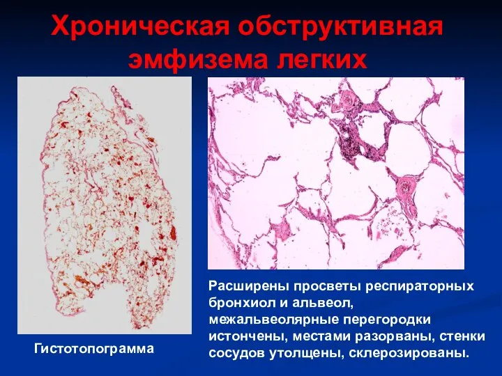 Хроническая обструктивная эмфизема легких Гистотопограмма Расширены просветы респираторных бронхиол и альвеол,