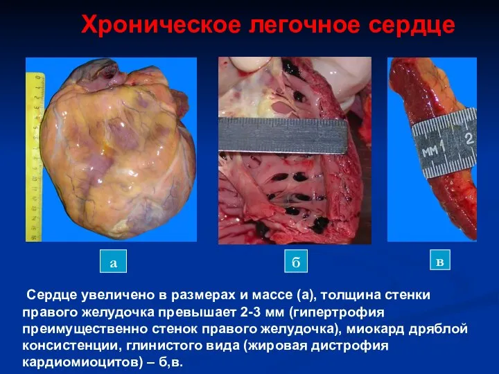 Сердце увеличено в размерах и массе (а), толщина стенки правого желудочка