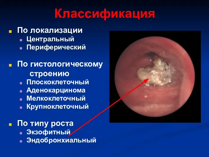 Классификация По локализации Центральный Периферический По гистологическому строению Плоскоклеточный Аденокарцинома Мелкоклеточный