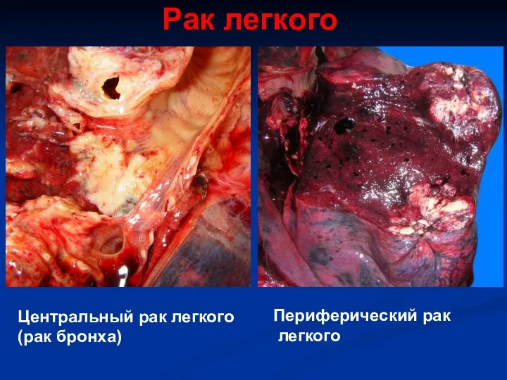 Рак легкого Центральный рак легкого (рак бронха) Периферический рак легкого