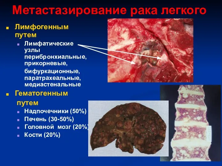 Метастазирование рака легкого Лимфогенным путем Лимфатические узлы перибронхиальные, прикорневые, бифуркационные, паратрахеальные,