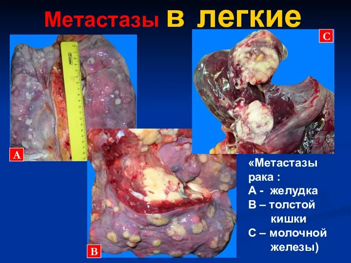 Метастазы в легкие «Метастазы рака : А - желудка В –