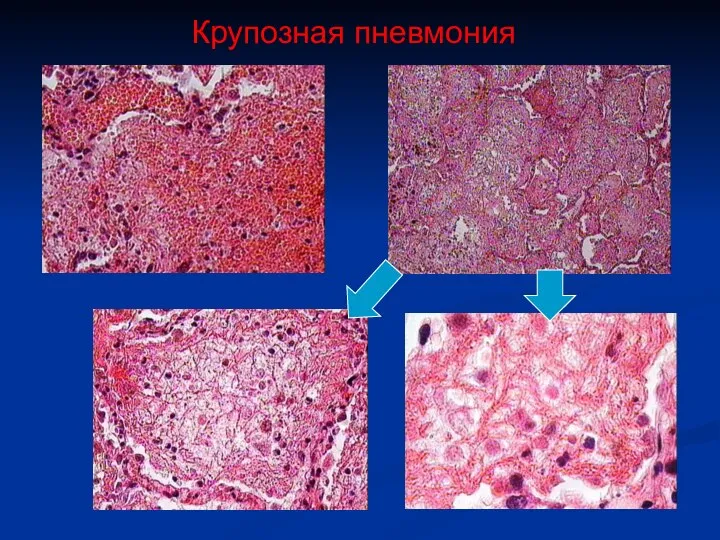 Крупозная пневмония