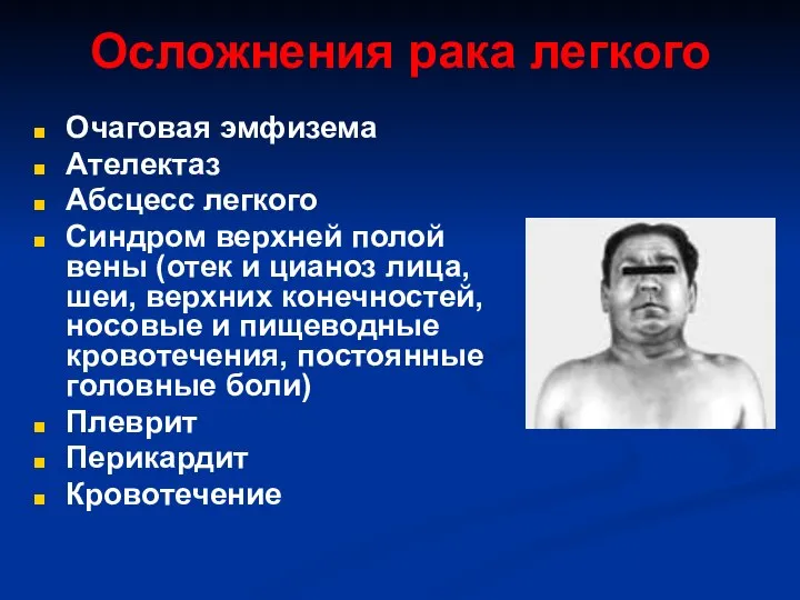 Осложнения рака легкого Очаговая эмфизема Ателектаз Абсцесс легкого Синдром верхней полой