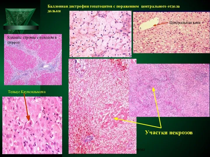 норма Тельце Каунсильмена Баллонная дистрофия гепатоцитов с поражением центрального отдела дольки