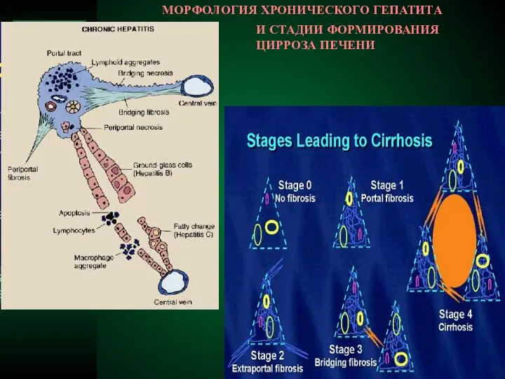 МОРФОЛОГИЯ ХРОНИЧЕСКОГО ГЕПАТИТА И СТАДИИ ФОРМИРОВАНИЯ ЦИРРОЗА ПЕЧЕНИ