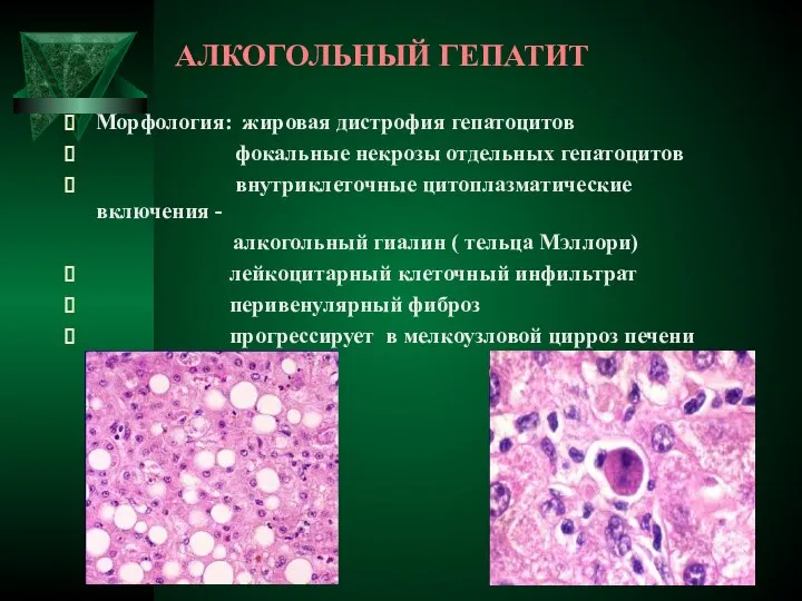 АЛКОГОЛЬНЫЙ ГЕПАТИТ Морфология: жировая дистрофия гепатоцитов фокальные некрозы отдельных гепатоцитов внутриклеточные
