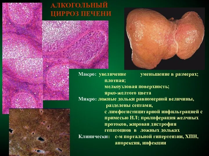 АЛКОГОЛЬНЫЙ ЦИРРОЗ ПЕЧЕНИ Макро: увеличение уменьшение в размерах; плотная; мелкоузловая поверхность;