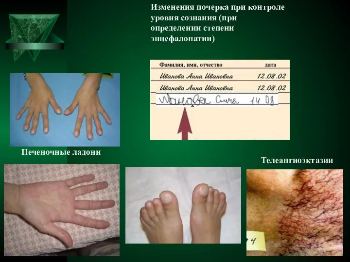 Печеночные ладони Телеангиоэктазии Изменения почерка при контроле уровня сознания (при определении степени энцефалопатии)