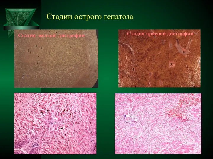 Стадии острого гепатоза гепатоз Стадия красной дистрофии Стадия желтой дистрофии