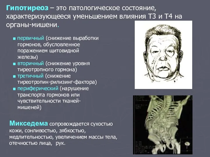 ■ первичный (снижение выработки гормонов, обусловленное поражением щитовидной железы) ■ вторичный