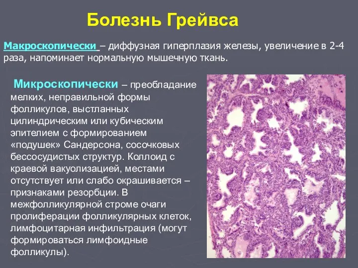 Болезнь Грейвса Макроскопически – диффузная гиперплазия железы, увеличение в 2-4 раза,