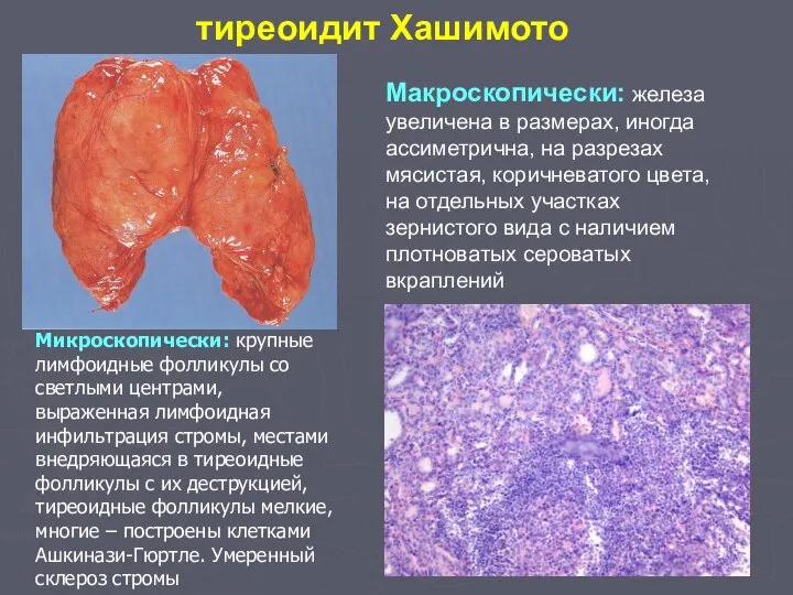 тиреоидит Хашимото Макроскопически: железа увеличена в размерах, иногда ассиметрична, на разрезах