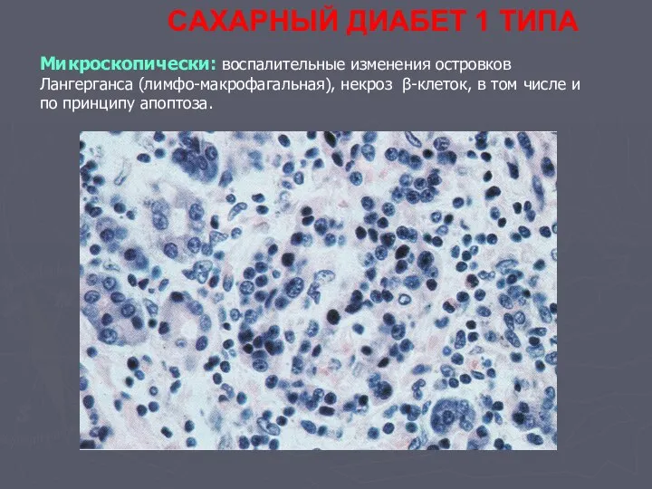 САХАРНЫЙ ДИАБЕТ 1 ТИПА Микроскопически: воспалительные изменения островков Лангерганса (лимфо-макрофагальная), некроз