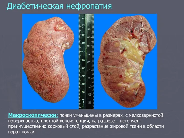 Диабетическая нефропатия Макроскопически: почки уменьшены в размерах, с мелкозернистой поверхностью, плотной