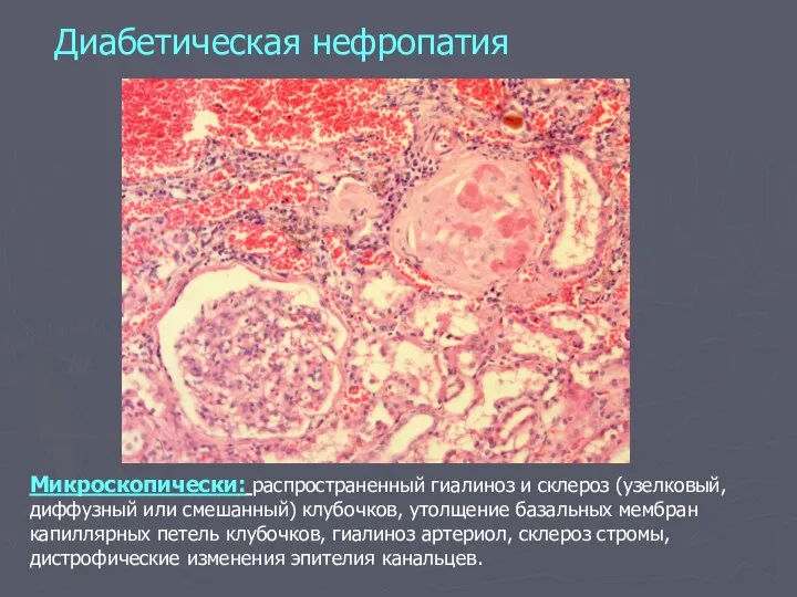 Диабетическая нефропатия Микроскопически: распространенный гиалиноз и склероз (узелковый, диффузный или смешанный)