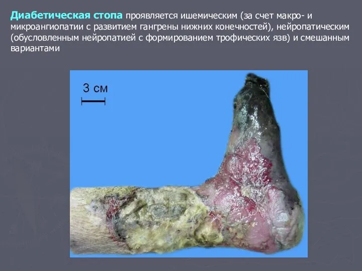 Диабетическая стопа проявляется ишемическим (за счет макро- и микроангиопатии с развитием