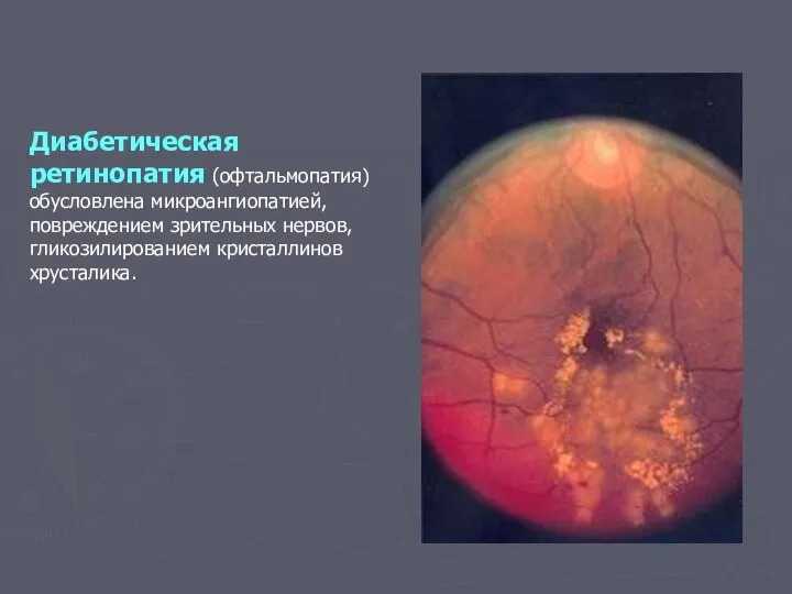 Диабетическая ретинопатия (офтальмопатия) обусловлена микроангиопатией, повреждением зрительных нервов, гликозилированием кристаллинов хрусталика.