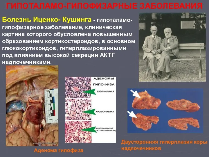 ГИПОТАЛАМО-ГИПОФИЗАРНЫЕ ЗАБОЛЕВАНИЯ Болезнь Иценко- Кушинга - гипоталамо-гипофизарное заболевание, клиническая картина которого