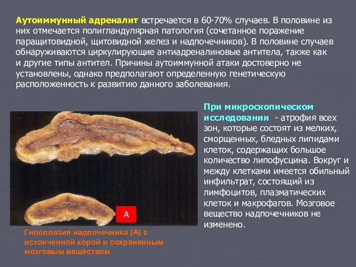 Аутоиммунный адреналит встречается в 60-70% случаев. В половине из них отмечается