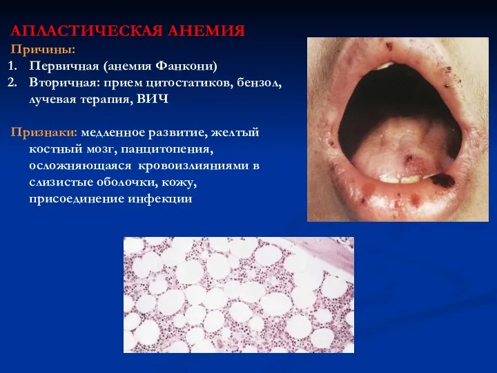 АПЛАСТИЧЕСКАЯ АНЕМИЯ Причины: Первичная (анемия Фанкони) Вторичная: прием цитостатиков, бензол, лучевая