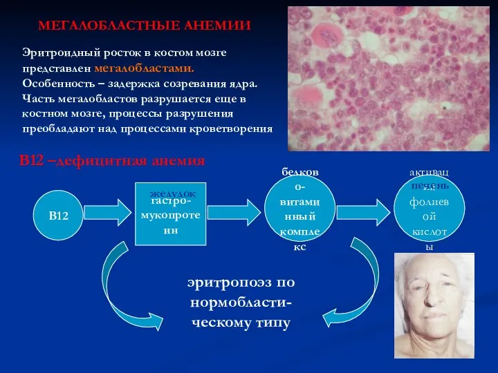 МЕГАЛОБЛАСТНЫЕ АНЕМИИ Эритроидный росток в костом мозге представлен мегалобластами. Особенность –