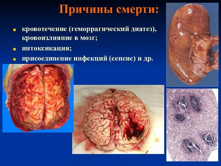 Причины смерти: кровотечение (геморрагический диатез), кровоизлияние в мозг; интоксикация; присоединение инфекций (сепсис) и др.
