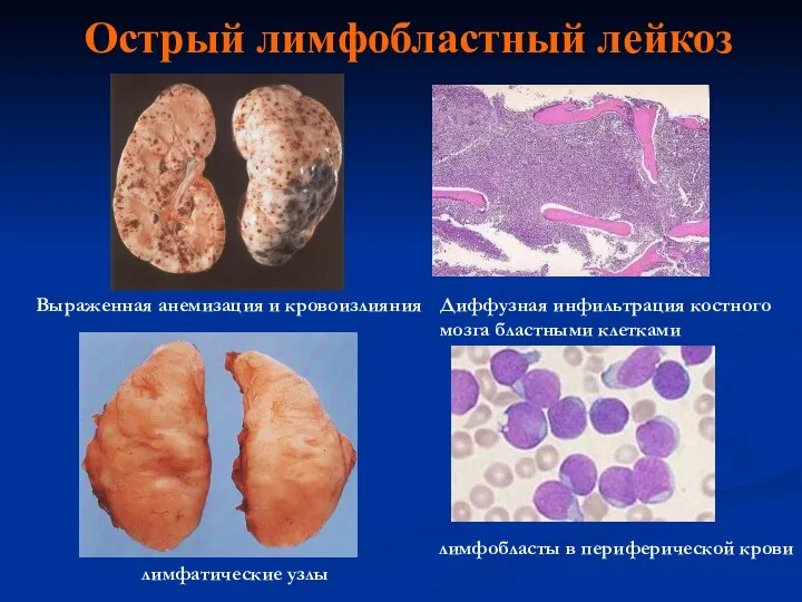 Острый лимфобластный лейкоз Диффузная инфильтрация костного мозга бластными клетками лимфобласты в