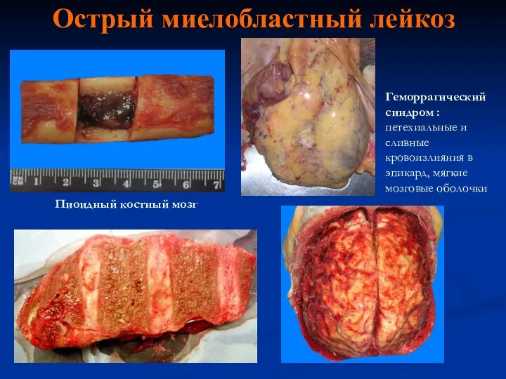 Острый миелобластный лейкоз Пиоидный костный мозг Геморрагический синдром : петехиальные и