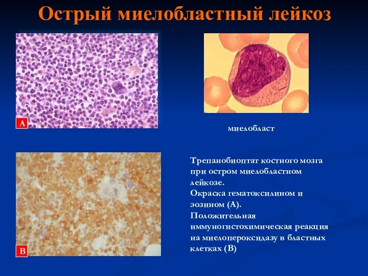 Острый миелобластный лейкоз миелобласт Трепанобиоптат костного мозга при остром миелобластном лейкозе.