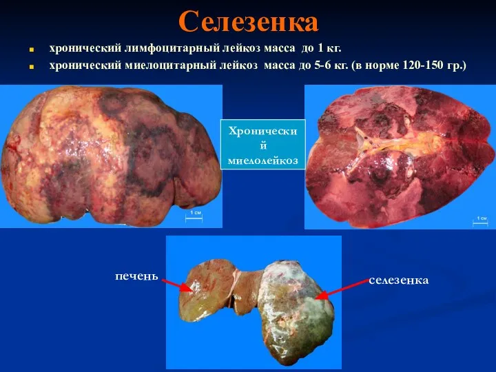 Селезенка хронический лимфоцитарный лейкоз масса до 1 кг. хронический миелоцитарный лейкоз